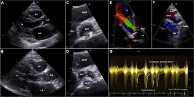 A percutaneous treatment strategy of an adult patient with a bicuspid aortic valve, coarctation of the aorta, and an exceptionally large aneurysm of a collateral artery: Case report and literature overview